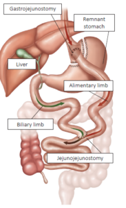 A diagram of the stomach and it shows a small stomach pouch attached near the top of the stomach and joined to the bowel. 
