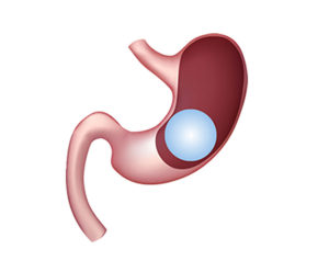 A diagram of the stomach with a silicone balloon placed inside the stomach. 