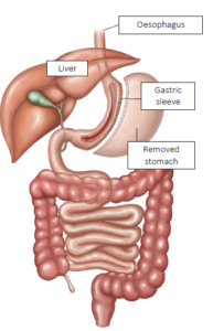 A diagram of the stomach where a gastric sleeve has been attached to the stomach and a portion of the stomach has been removed making it smaller. 